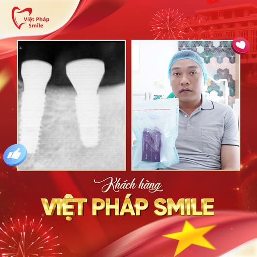 Trồng răng Implant tại Phường Trung Mỹ Tây (Quận 12 cũ): Nên chọn nha khoa nào để an tâm lâu dài? 3 trong-rang-implant-khong-dau-1