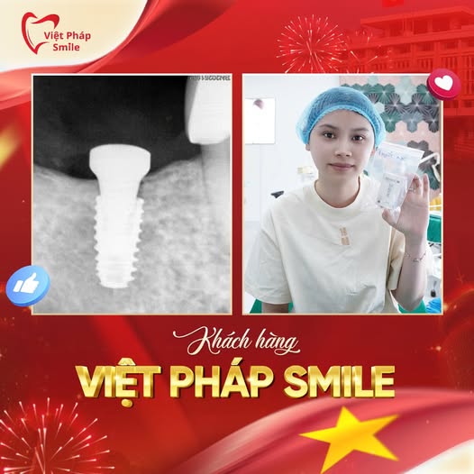 Trồng răng Implant tại Phường Trung Mỹ Tây (Quận 12 cũ): Nên chọn nha khoa nào để an tâm lâu dài? 4 trong-rang-implant-khong-dau