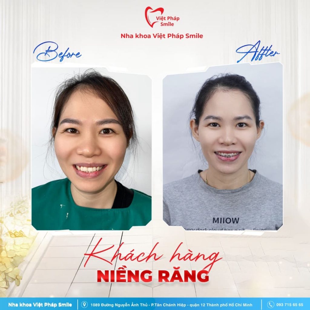 Niềng răng giá bao nhiêu tại nha khoa quận 12 - Nha khoa niềng răng uy tín 10 KHACH-HANG-NIENG-RANG-NHA-KHOA (7)