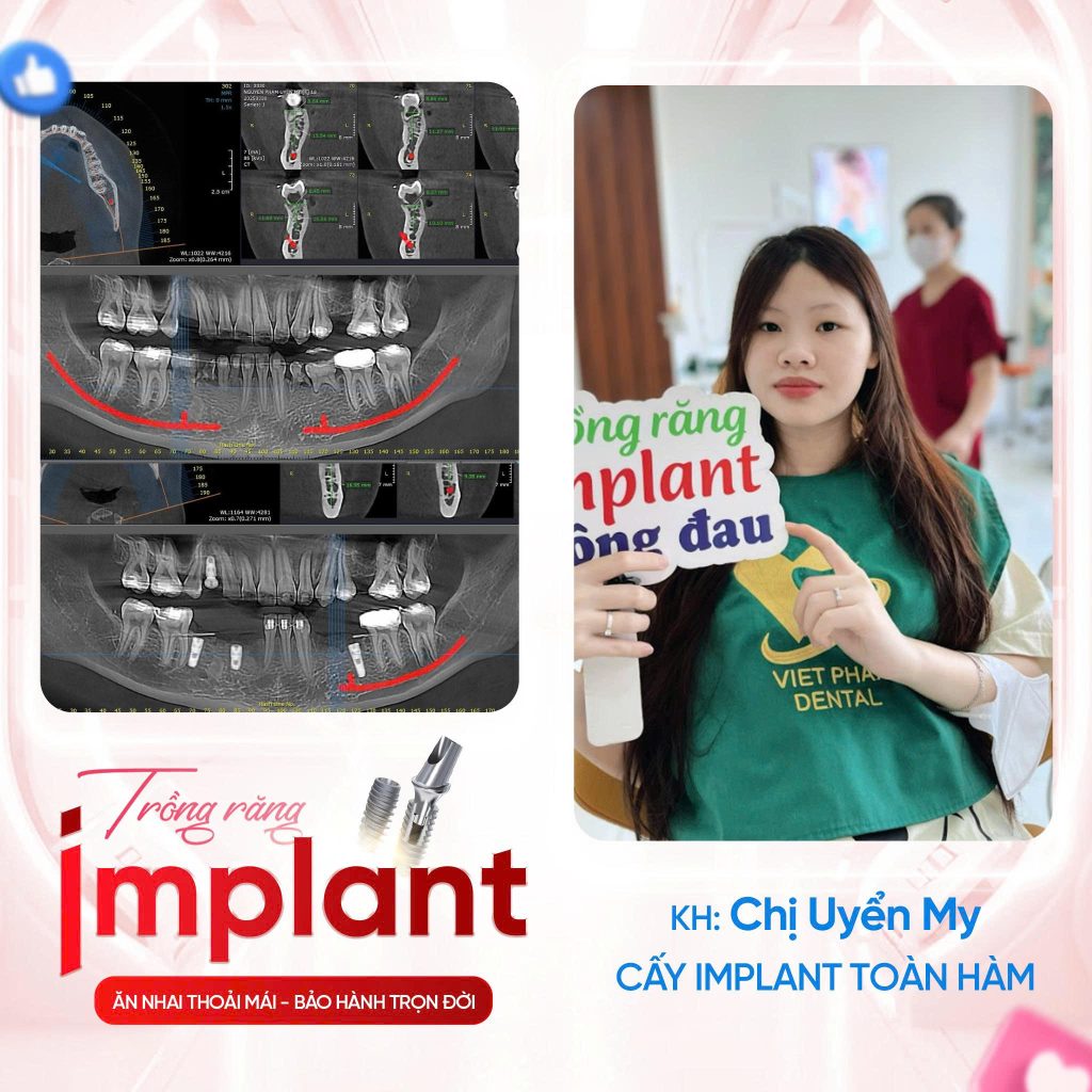 KHACH-HANG-TRONG-IMPLANT (3)