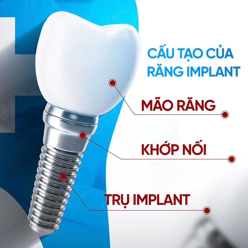 cau-tao-cua-rang-implant-