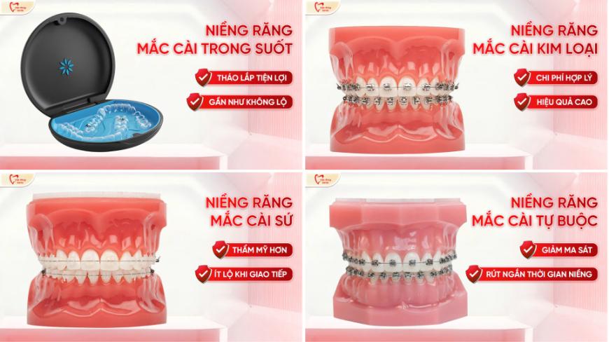 Các phương pháp niềng răng phổ biến hiện nay