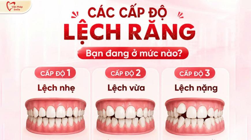 Bảng giá niềng răng mới nhất tại Việt Pháp Smile cập nhật 2026 3 Mức độ lệch lạc của răng