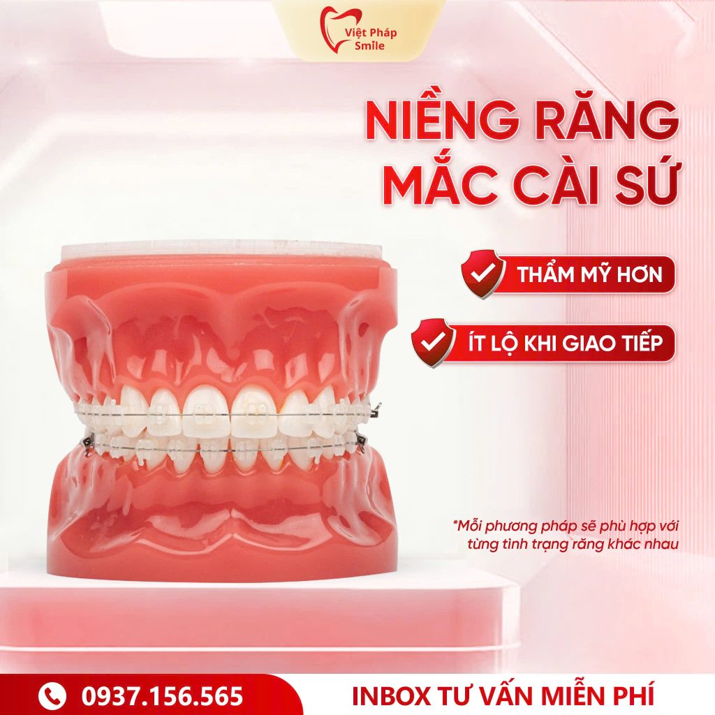 Niềng răng mắc cài sứ – Tăng tính thẩm mỹ khi giao tiếp