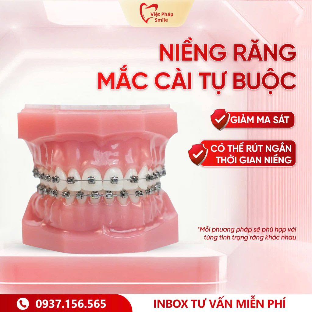 Niềng răng mắc cài tự buộc – Hạn chế ma sát và giảm số lần tái khám