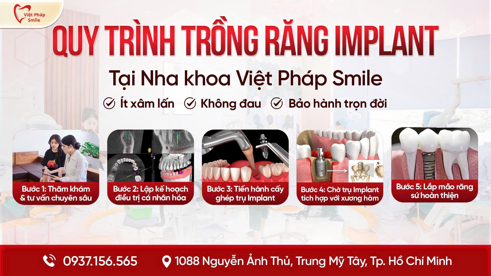 Quy Trình Điều Trị An Toàn, Hướng Đến Trải Nghiệm Trồng Implant Không Đau