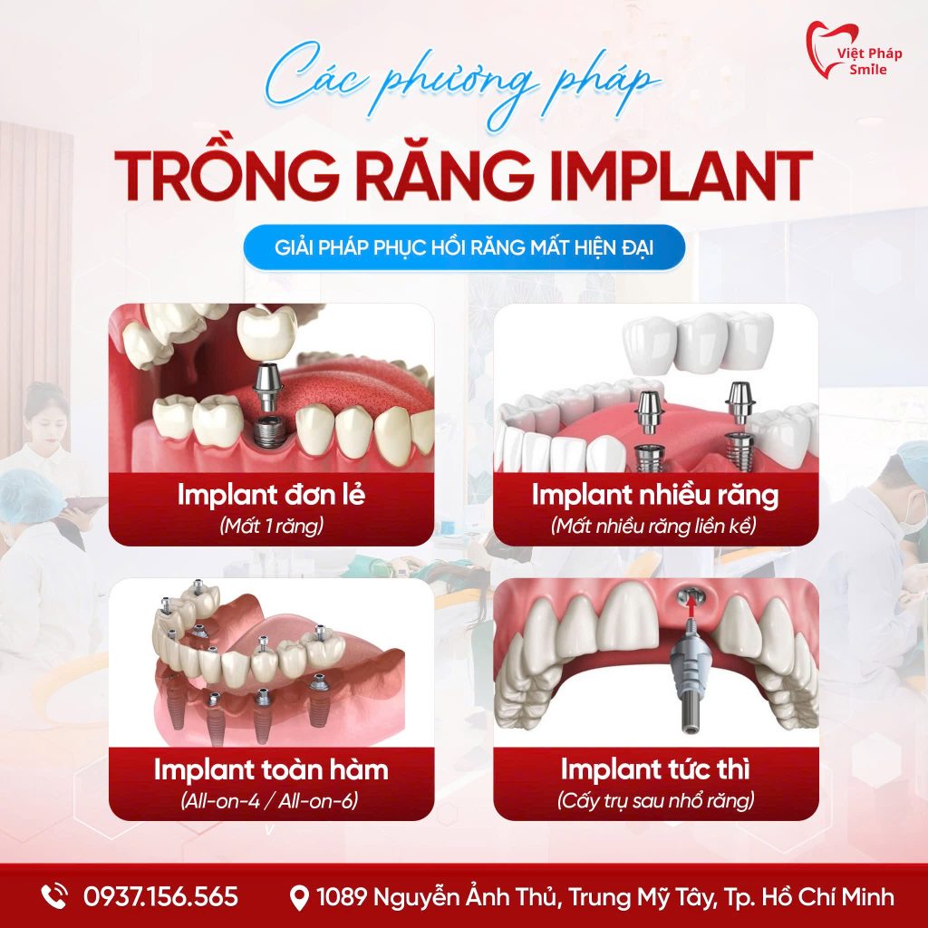 các phương pháp Trồng Răng Implant