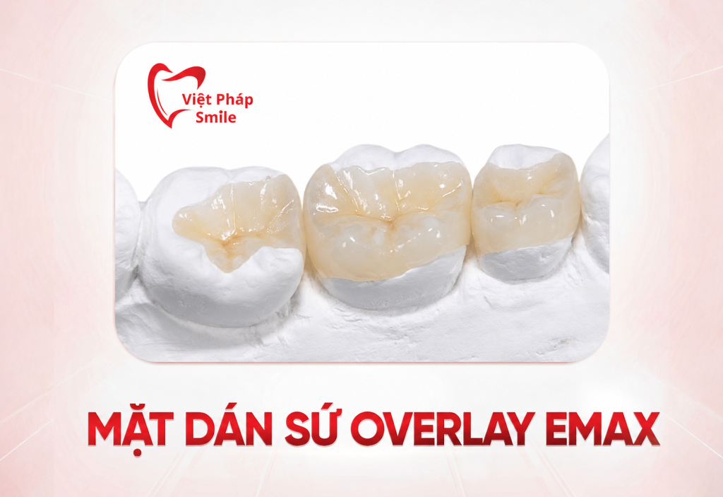 mặt dán sứ Overlay Emax